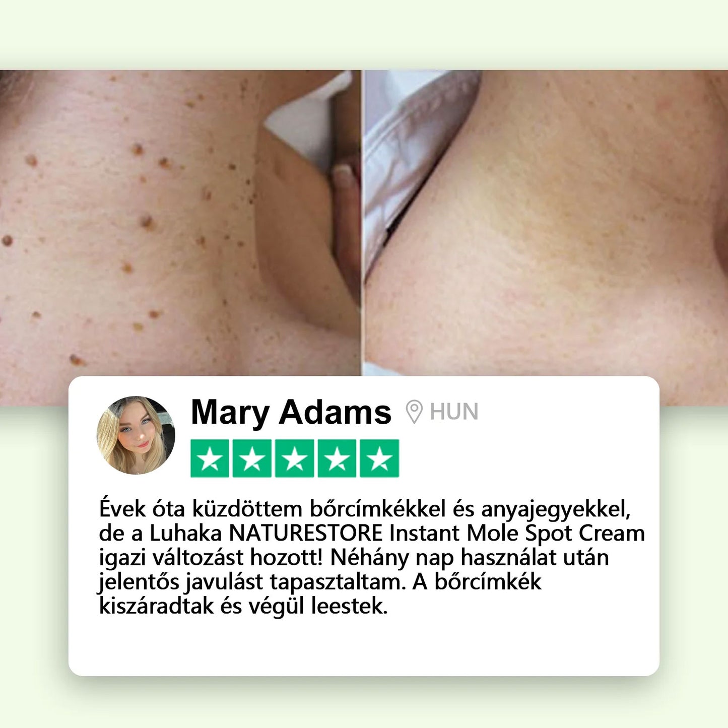 Luhaka® NATURE STORE Azonnali Anyajegy- és Pattanás elleni Krém_Ultra01